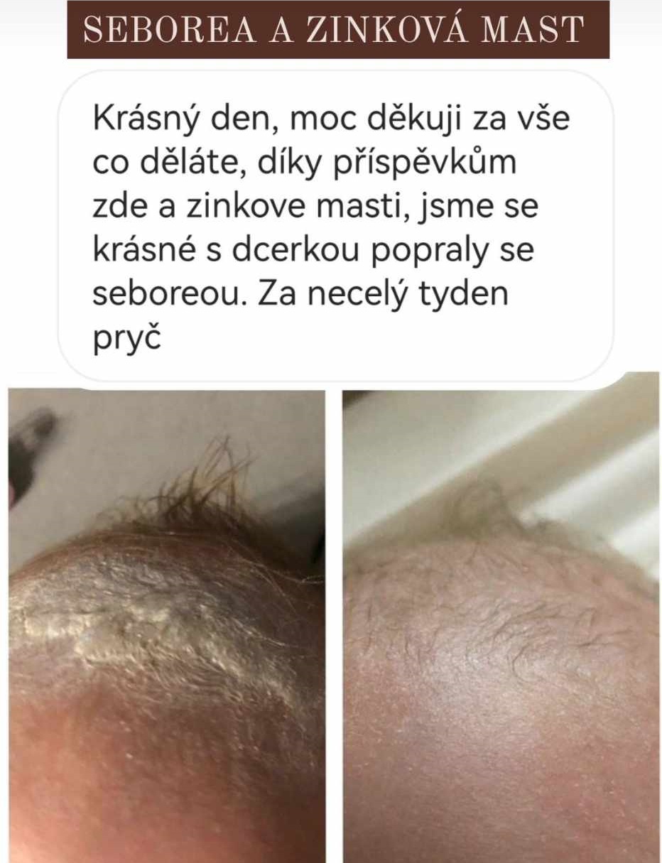 Seborea a Zinková mast medarek